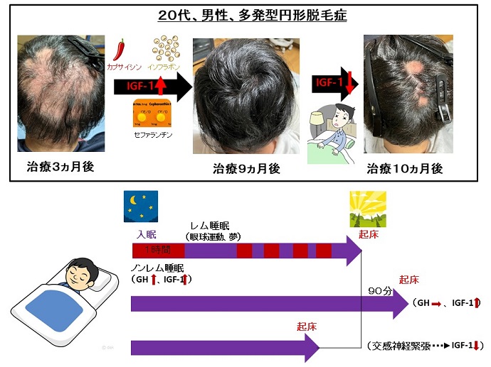 円形脱毛症　病院